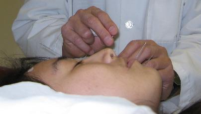 Acupuncture Treatment
